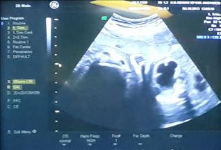 Anne karnındaki bebeğe böbrek ameliyatı