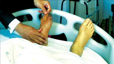 'Diyabetik Ayak' raporu yayımlandı 