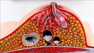 إصابة "أسماء الأسد" بسرطان الثدي