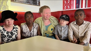 'People with albinism face discrimination in Uganda'