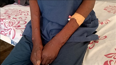 Zambia records first mpox case: Health minister