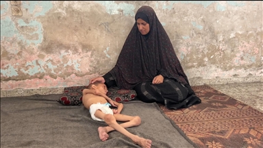 غزة.. الطفل نافذ يصارع التجويع والمرض بجسد نحيل