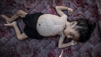 6 وفيات جراء التجويع الإسرائيلي بغزة ترفع الحصيلة لـ399 