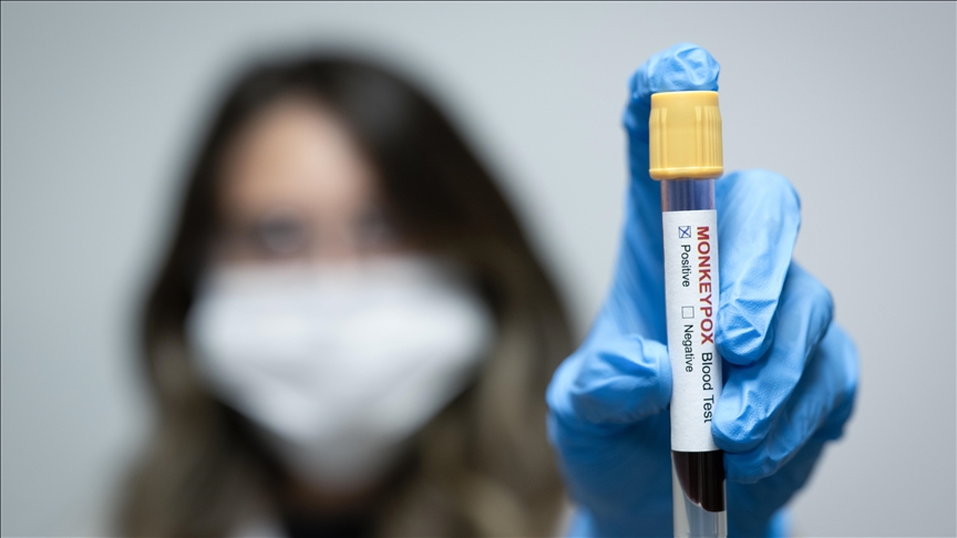 Contact tracing launched after mpox claims lives of 4 children in southern Pakistan  Anadolu Ajansı