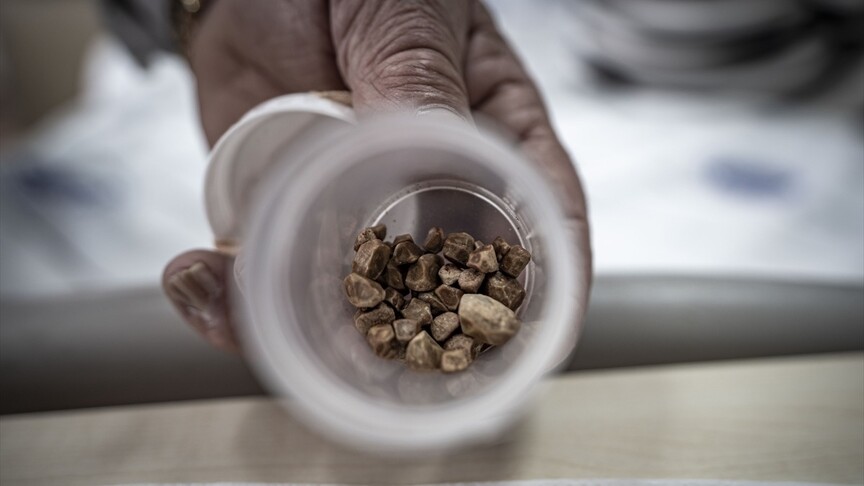 **Tarihte Kaydedilen En Fazla Taşlı İdrar Hafızası**