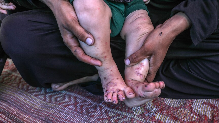 Skin infections in Gaza tripling amid worsening shelter crisis: UN