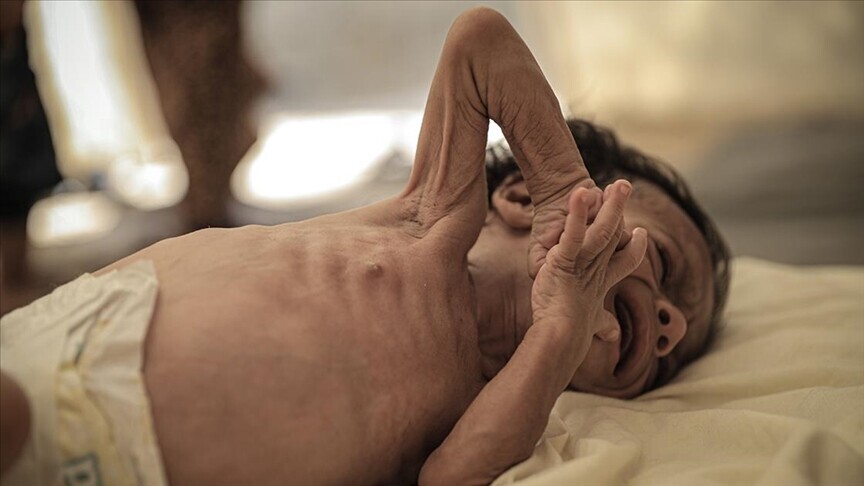 Bangladeş'te 15 Mart'tan bu yana kızamık olduğu doğrulanan veya belirtileri görülen 528 çocuk öldü