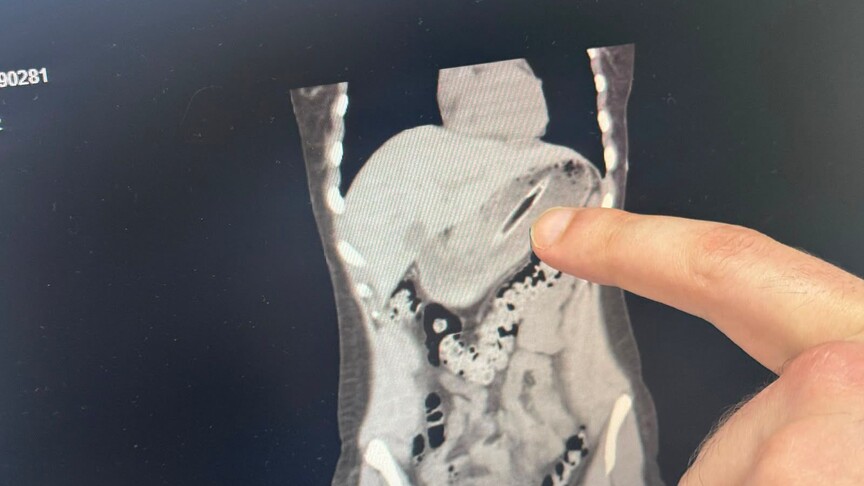 Zayıflamak için kendini kusturmaya çalışırken diş fırçası yuttu haber görseli